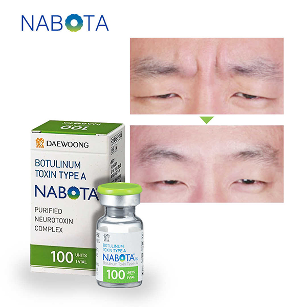  Nabota Botulinum Toxin Type A