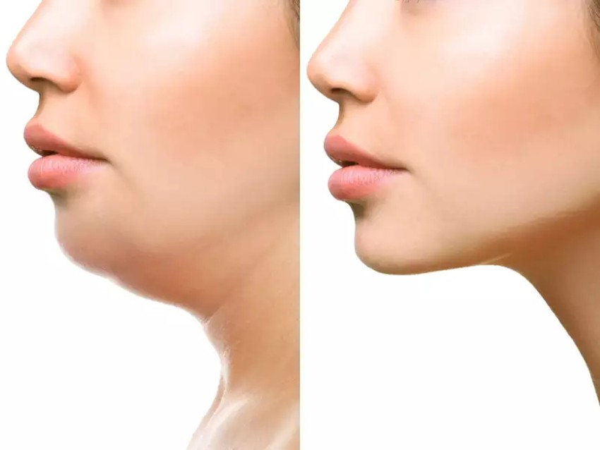 what-causes-a-double-chin-skinworks-dermatology-dermatology